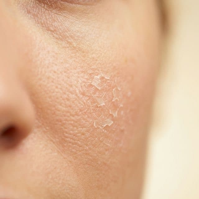 Da bong tróc châm chích khi thoa serum — dấu hiệu hàng rào da bị phá vỡ