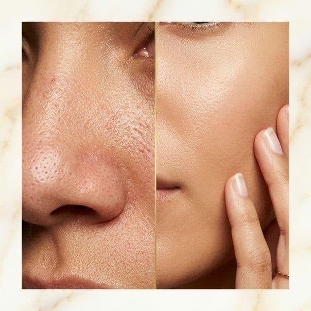 Lỗ chân lông to dần — suy thoái collagen quanh nang