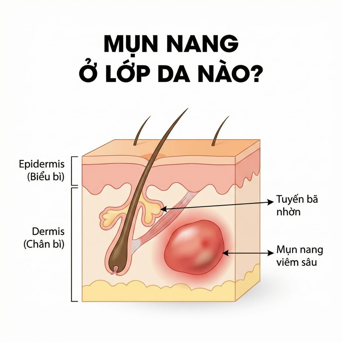 Sơ đồ cơ chế hình thành mụn bọc mụn nang