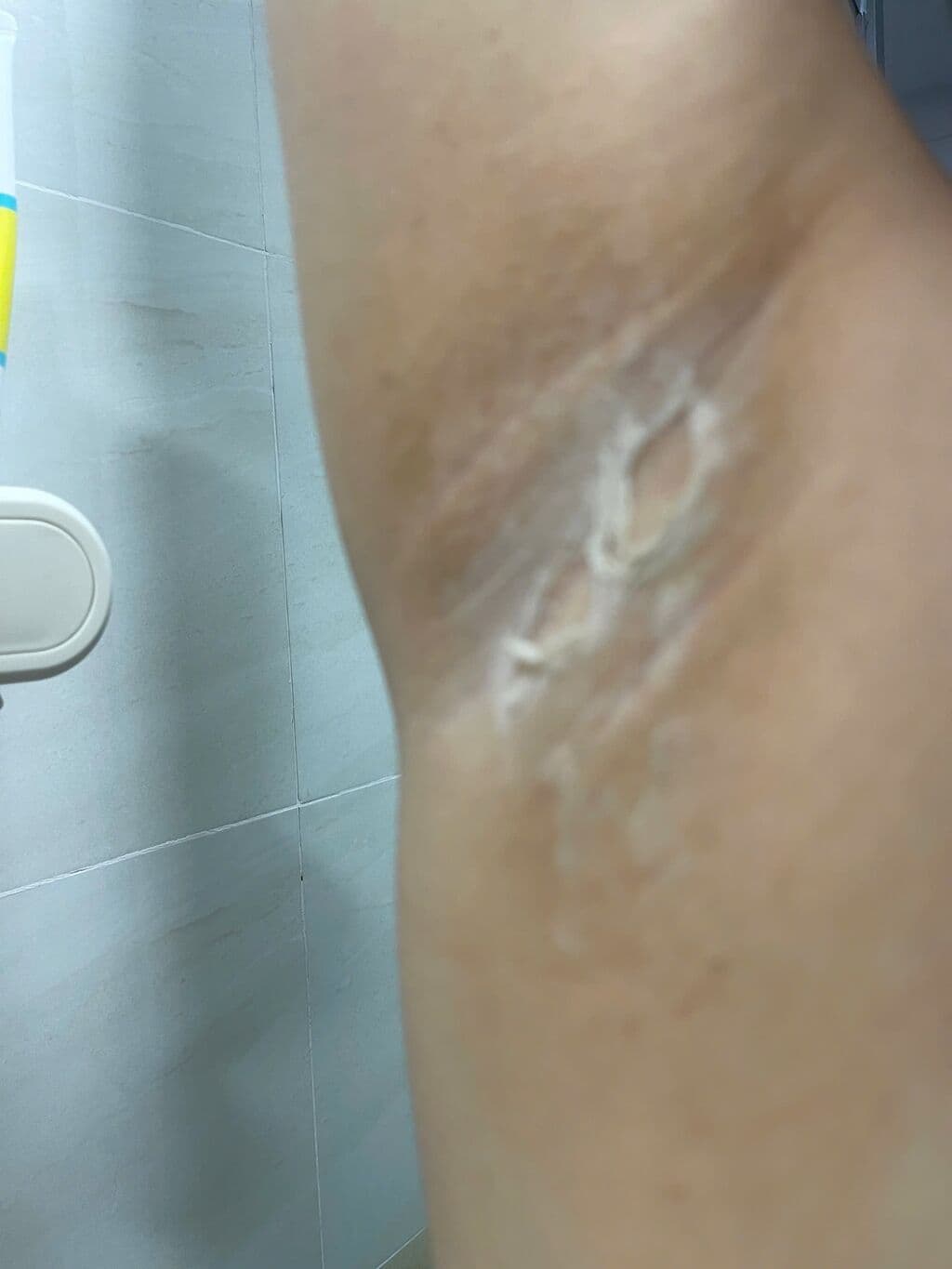 Soi da cấu trúc lỗ chân lông