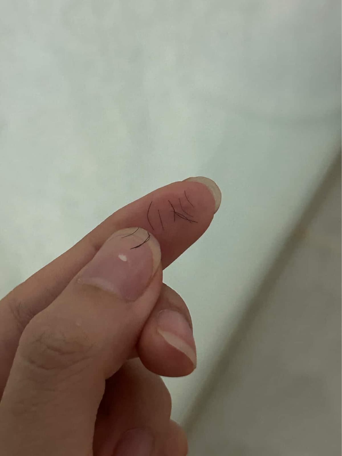 Hiệu quả lông rụng sau triệt