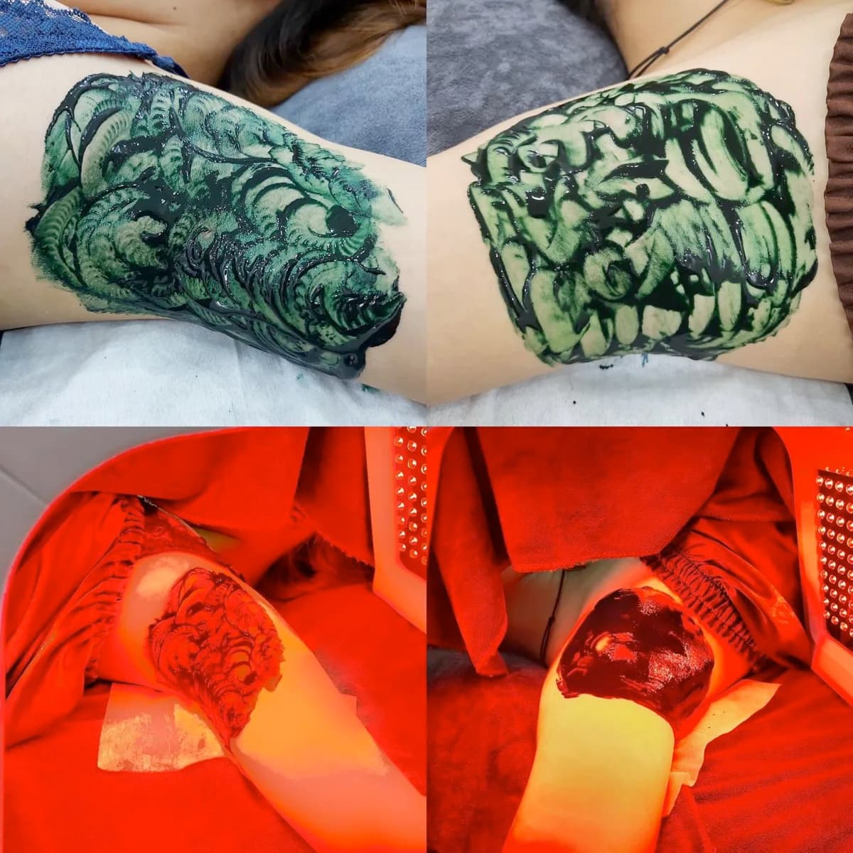 Cấy tảo xoắn trị thâm nách