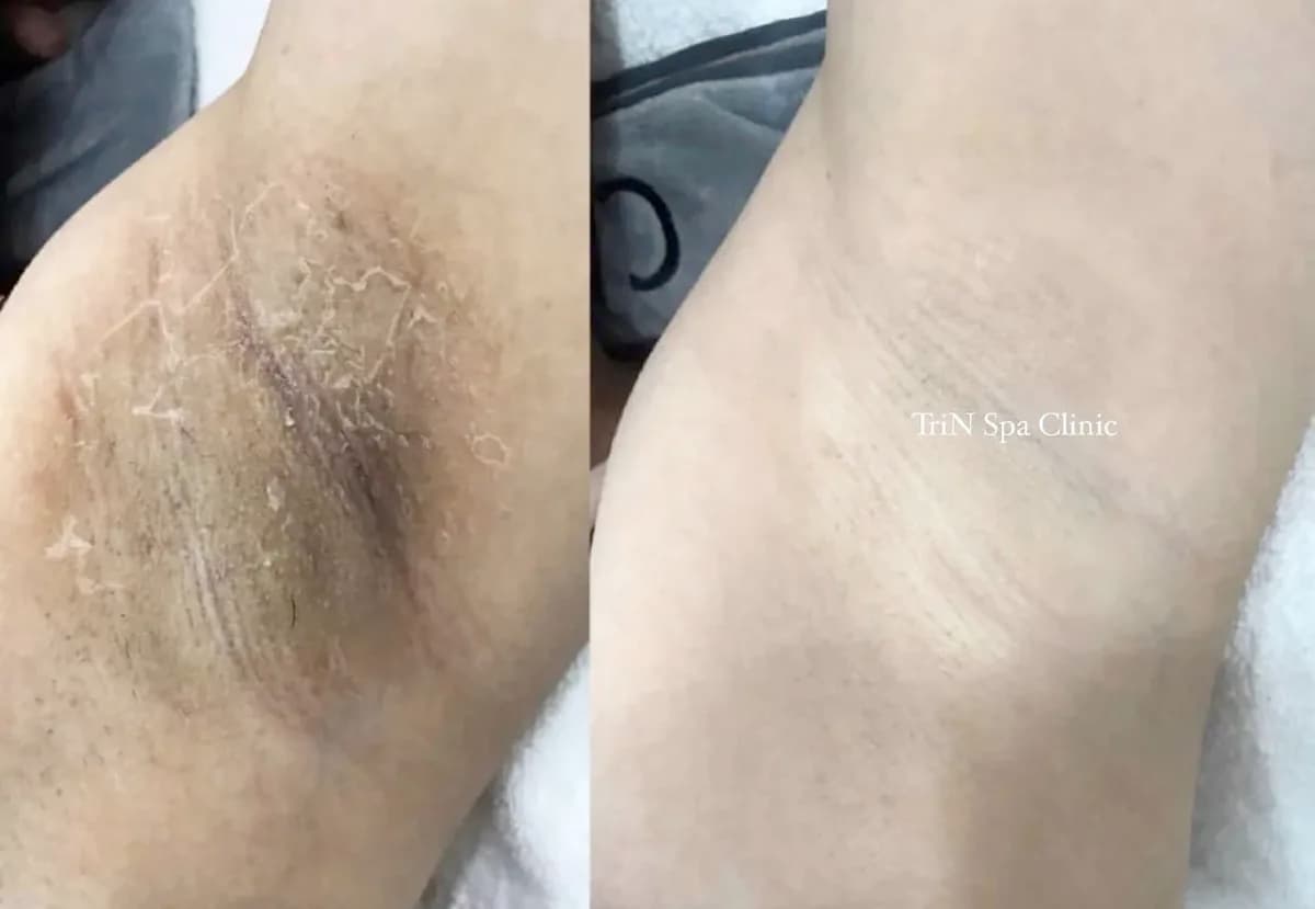 Trước và sau peeling trị thâm nách tại TriN Spa