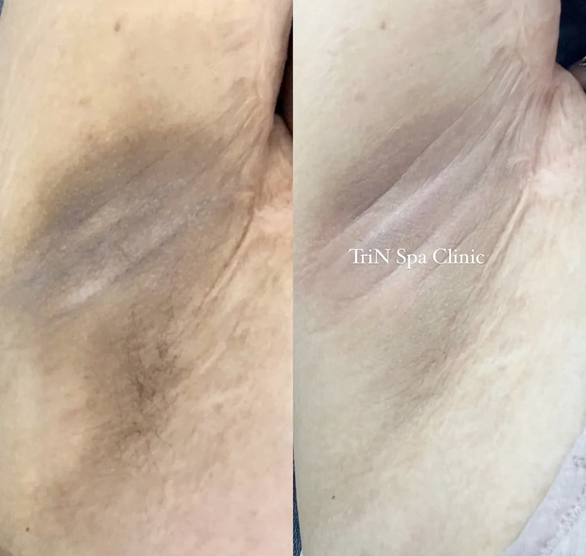 Peeling trị thâm nách — da bong sạch thâm