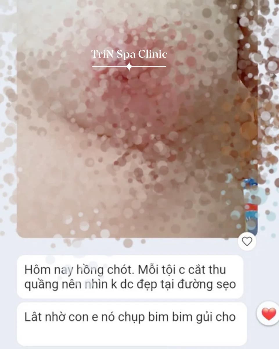 Thay da hoá học — bong sắc tố thâm