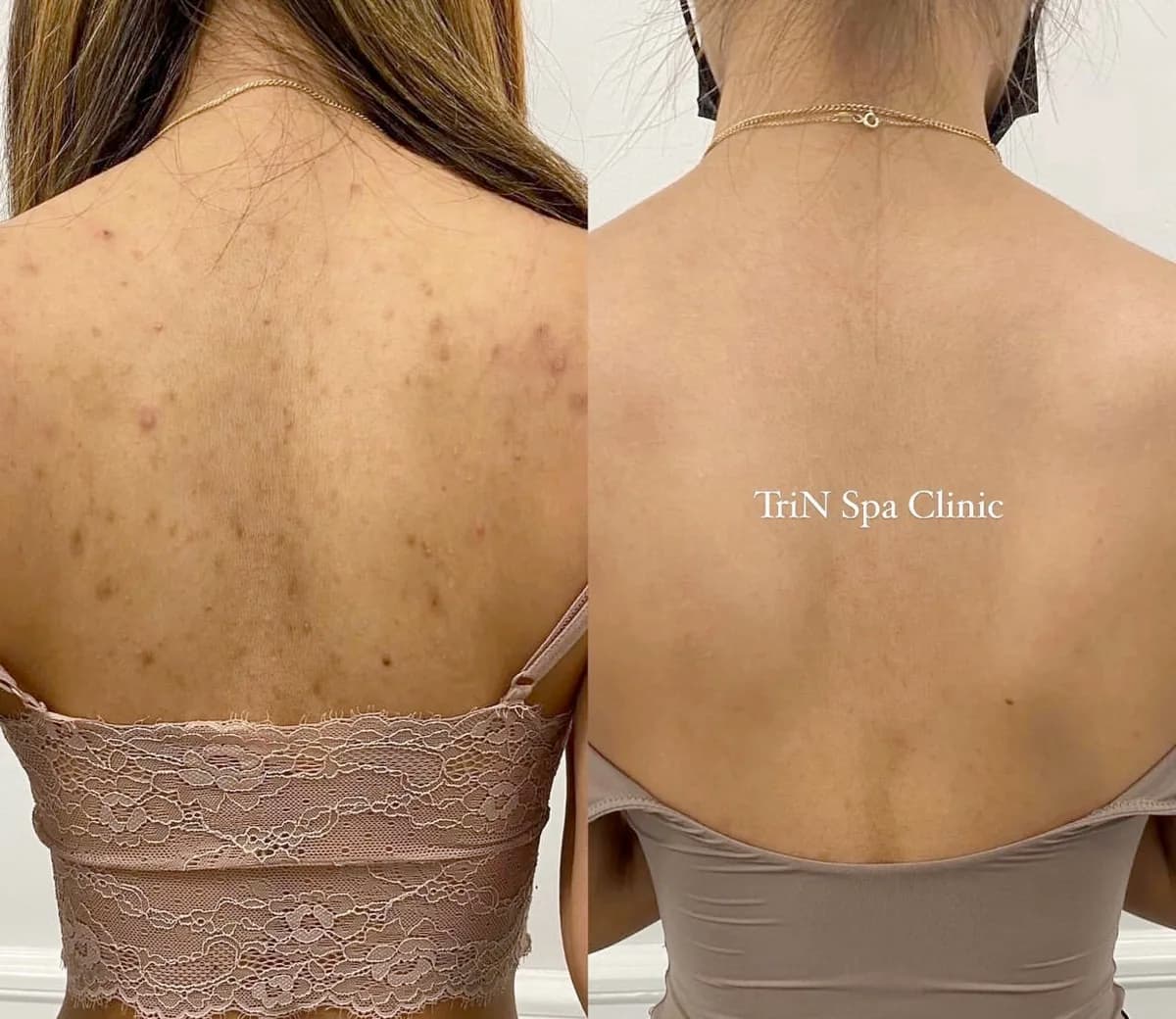 Trước và sau điều trị mụn thâm lưng tại TriN Spa
