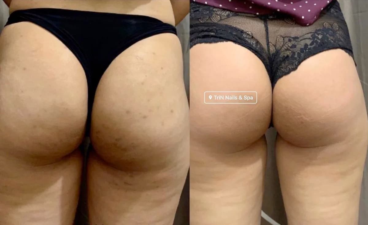 Trước và sau điều trị mụn thâm mông tại TriN Spa